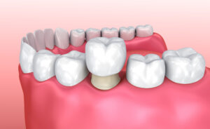 dental crowns Powell Pediatric Dentistry dentist in Clovis, CA
